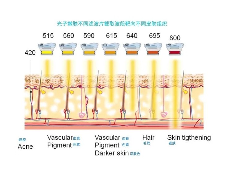 五大光子嫩膚技術(shù)（IPL、DPL、OPT、APT、BBL）及濾光片區(qū)別